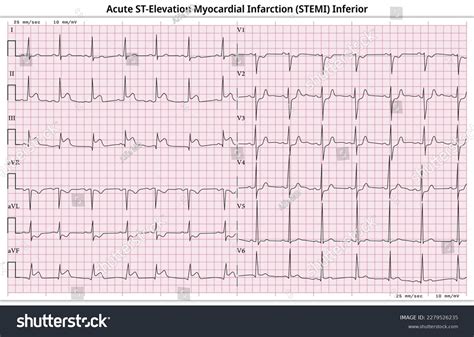 Inferior Infarct Ekg
