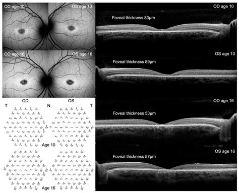 Rescue of Aberrant Splicing Caused by a Novel Complex Deep-intronic ...