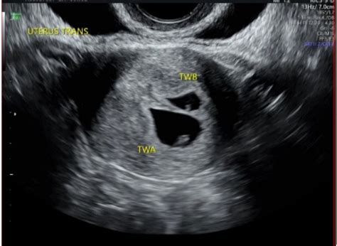 Twin Pregnancy - 6w Ultrasound, could only see 1 heartbeat. | BabyCenter