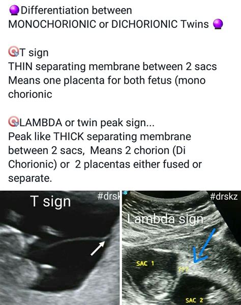Twin Peaks Sign Ultrasound