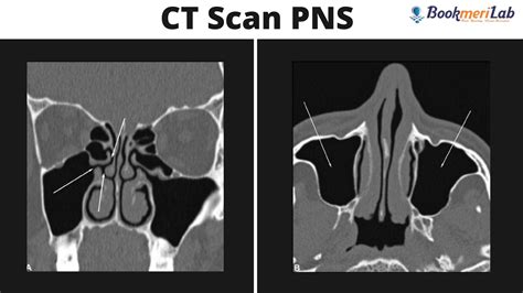 Pns Ct Anatomy
