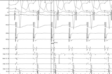 Supraventricular Tachycardia