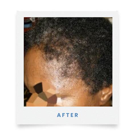 Traction Alopecia Surgery - Medical Hair Restoration