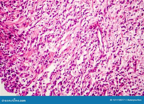 Signet ring cell carcinoma stock image. Image of pathology - 121118517