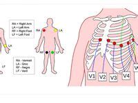 Image result for Lead Optimization Mapper Algorithm