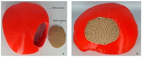 Polyether-Ether-Ketone (PEEK) and Its 3D-Printed Quantitate Assessment ...