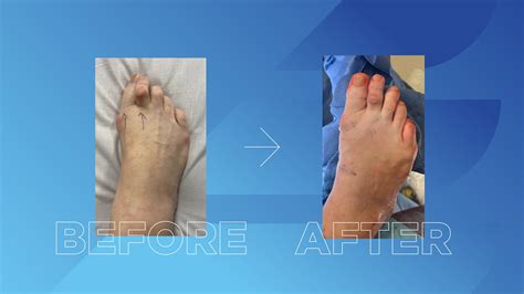 The Advantages of Minimally Invasive Bunion Surgery - Elevate Foot & Ankle