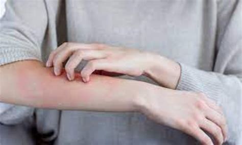 Memantine effective for Trichotillomania and skin-picking disorder