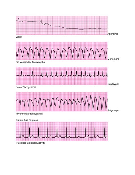Ventricular Fibrillation Vs Ventricular Tachycardia Ecg
