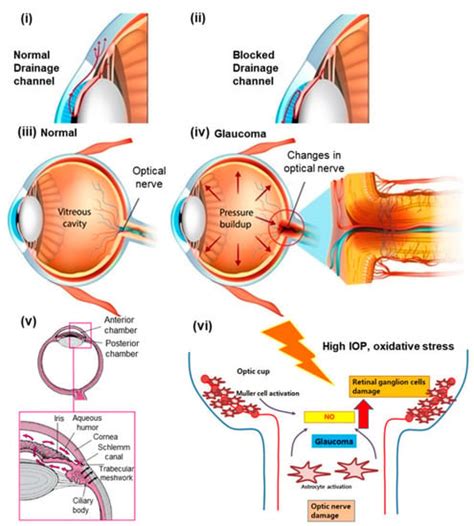 Recent Progress in Chitosan-Based Nanomedicine for Its Ocular ...