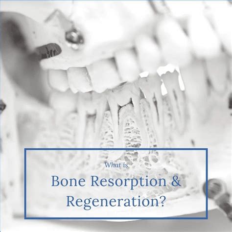 What Is Dental Bone Resorption at Talitha Williams blog