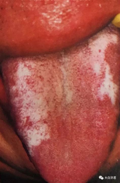 口腔毛状黏膜白斑口腔毛状粘膜白斑2022已更新今日图集