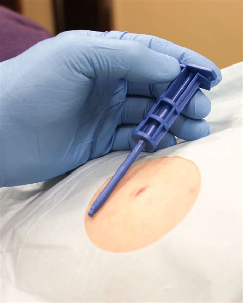 Denver Testosterone Pellet Therapy | Denver Hormone Health