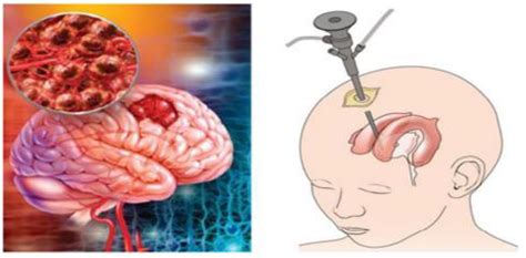 3D-MRI Brain Tumor Detection Model Using Modified Version of Level Set ...