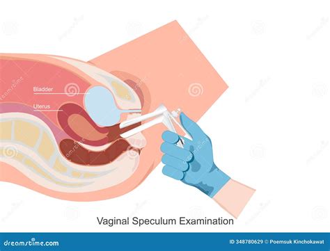 Vaginal Speculum Examination Stock Vector - Illustration of prevention ...