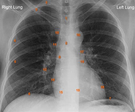 Image result for Chest X-Ray Tutorial