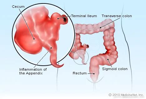 Image result for Appendicitis