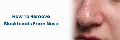 How to Remove Blackheads from Nose