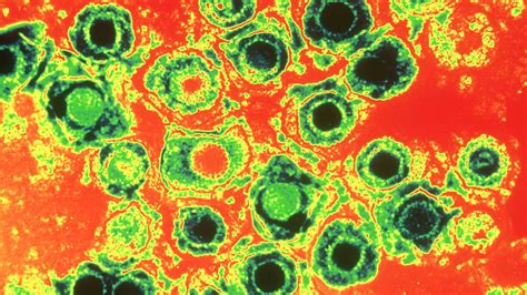 Cold Sore Home Remedies and Treatment Options | Everyday Health