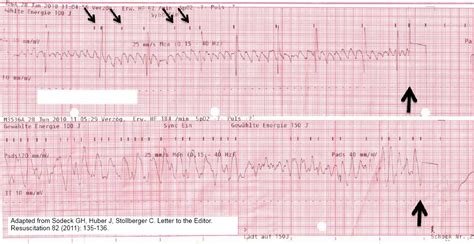 Image result for Atrial Flutter Synchronized Cardioversion
