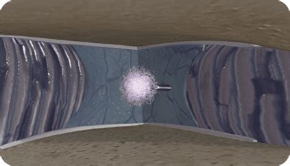 Image result for Via Disc Procedure