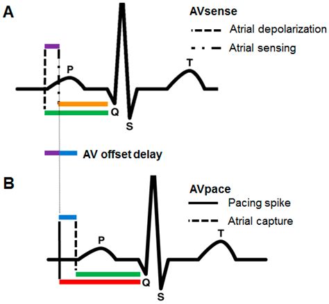Atrial Depolarization