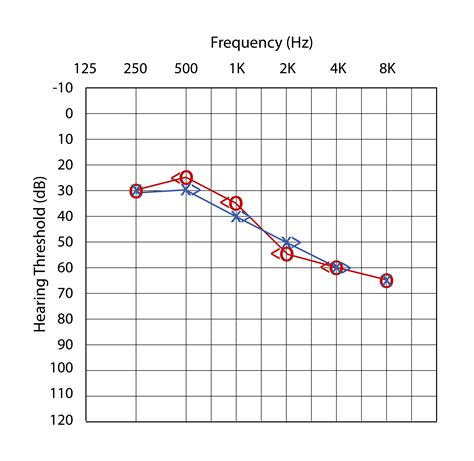 Bilateral Sensorineural Hearing Loss