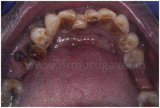 » FULL MOUTH REHABILITATION FOR A PATIENT SUFFERING WITH SEVERE ...