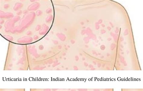 Urticaria in Children: Indian Academy of Pediatrics Guidelines