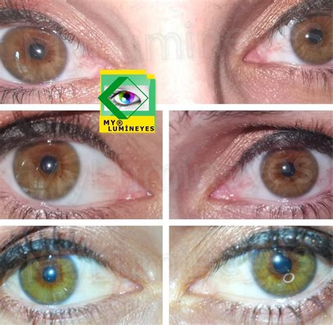 Image result for Eye Color Change Procedure
