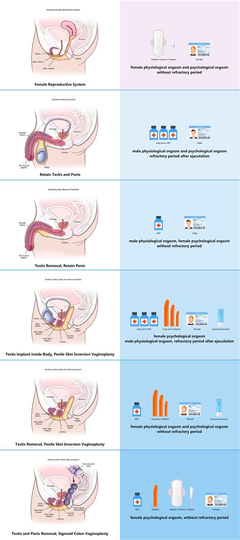 Male-to-female Sex Reassignment Surgery by FeLily82 on DeviantArt