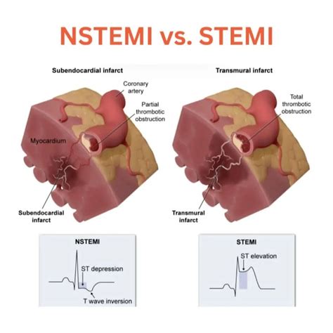 Learning of ECG Interpretation | STEMI vs NSTEMI #heartattack# #ecginterpretation #ecg # ...