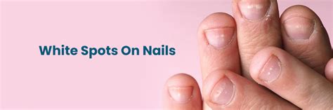 White Spots on Nails: Causes and Remedies