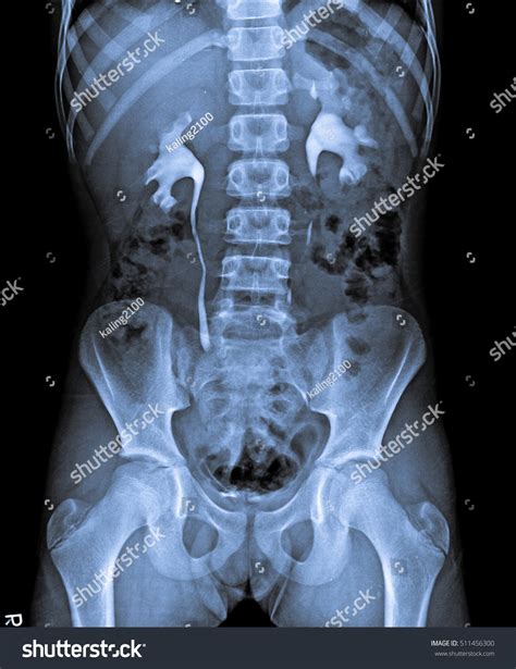 How To Prepare For An X Ray Kidney Ureter Bladder Without Stress