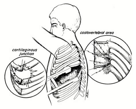 Image result for Thoracotomy Recovery