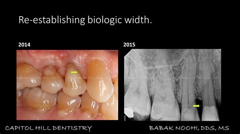 Decayed Tooth Pulling 的图像结果
