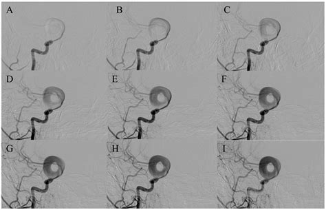 Ring-like (Donut-Shaped) Intracranial Aneurysms: A Warning Morphology ...