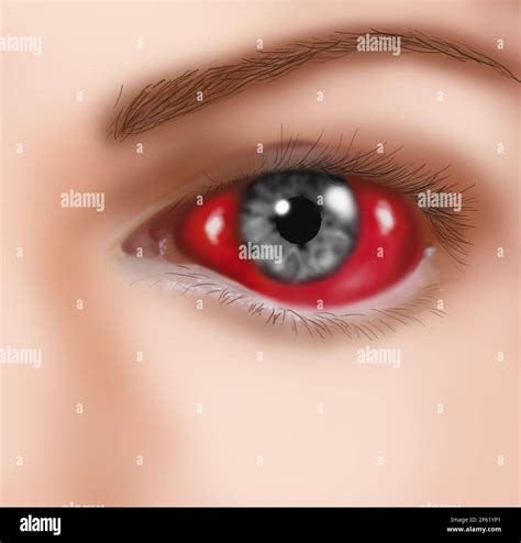Eye hemorrhage hi-res stock photography and images - Alamy