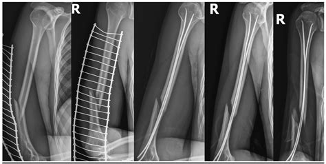 Radial Nerve Humerus