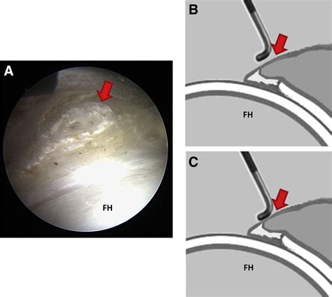 Labrum Test 的图像结果