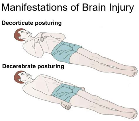Decorticate and decerebrate posturing causes & treatment