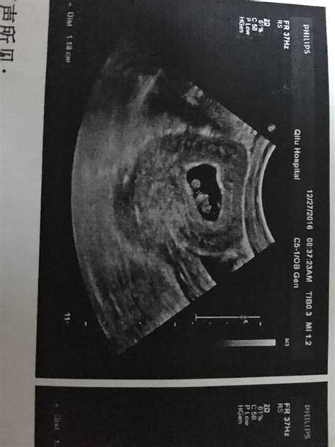 b超三个月胎儿两腿中间有白点_b超两腿中间有一个亮点是什么 - 随意云