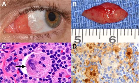 Rosai-Dorfman Disease - Ophthalmology