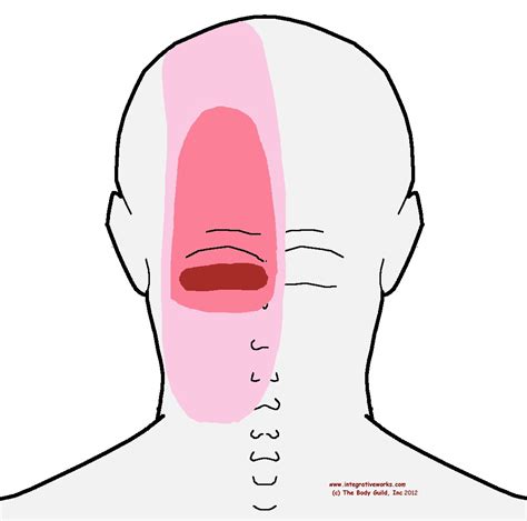 What Is Headache At Base Of Skull at Fred Patti blog