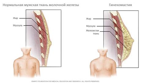 Гинекомастия у мужчин: лечение - Premium Aesthetics