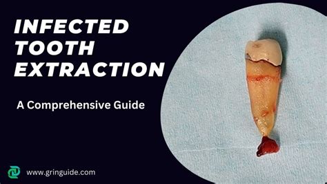 Infected Tooth Extraction Procedure 的图像结果