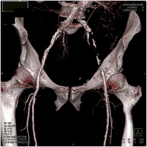 Aortic Aneurysm with Occluded Left Common Iliac Artery - Vascular Radiology Case Studies ...