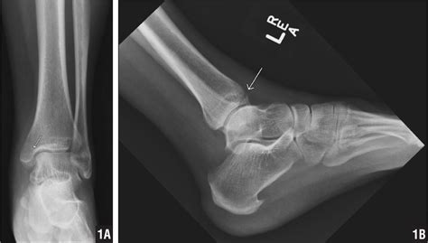 Ankle Fracture Following Hip Arthroscopy