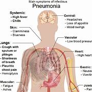 Image result for Pneumonia Symptoms