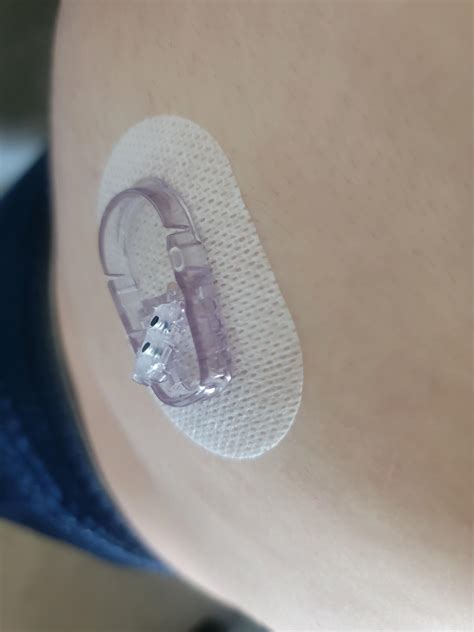 Image result for Dexcom Keeps Loosing Sensor Signal